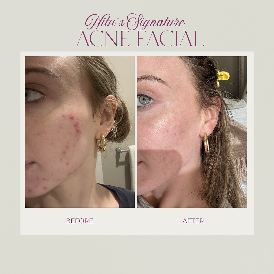 Acne Facial Before and After